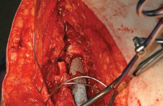 Illustration 88 for Femoral Stem Revision: Posterior Approach for Better Outcomes