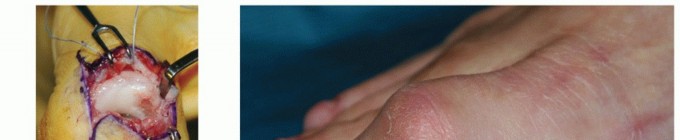 End Your Pain: Hallux IPJ Arthrodesis for Cockup Toe Deformity