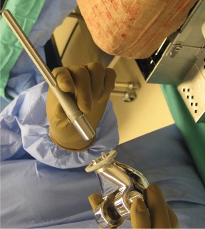 Illustration 48 for Hinged Total Knee: The Salvage Solution for Challenging Cases