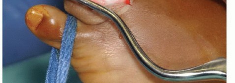 Illustration 21 for Avoid Major Surgery: Bone Tumor Treatment with Liquid Nitrogen Pour