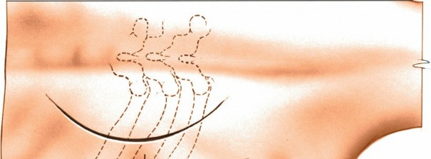 Illustration 290 for Approach to the Lumbar Spine: Mastering Techniques & Anatomy