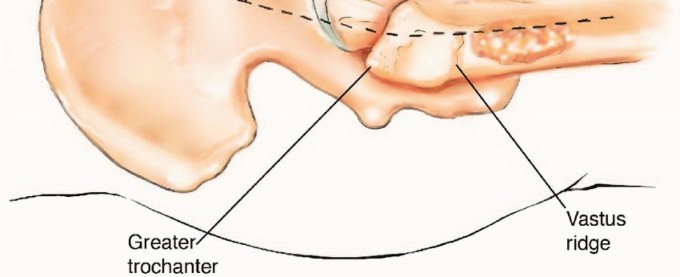Illustration 5 for Mastering Femoral Metastases: Optimal Function for Femoris & Vastus