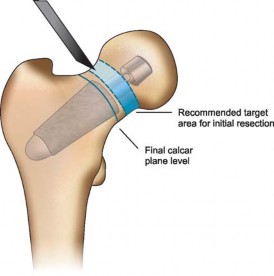 Illustration 19 for The Silent Hip: Achieving a Truly Silent, Pain-Free Joint