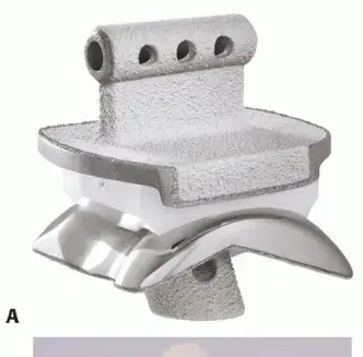 صورة توضيحية لـ وداعاً لألم الكاحل المزمن: دليل شامل لعملية استبدال مفصل الكاحل الكلي بتقنية سالطو