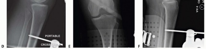 Illustration 22 for Repairing Distal Femur Fractures: Open Reduction & Internal Fixation