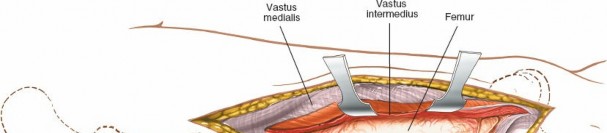 Illustration 33 for Optimal Femoral Approaches: Mastering the Lateral Intermuscular Septum