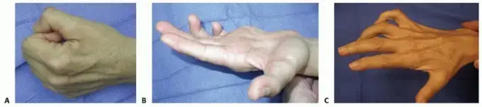 شلل العصب الزندي: دليل شامل للمرضى حول الأسباب، الأعراض، وطرق العلاج المتطورة في اليمن والخليج