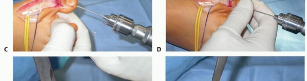 Illustration 28 for How Achilles Tendon Lengthening Fixes Equinocavovarus Foot