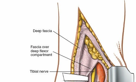 Illustration 51 for Optimized Approaches to the Dorsum of the Foot & Ankle