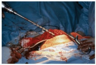 Illustration 7 for Recreate Hip Biomechanics: Modular Stems for Modular Solutions