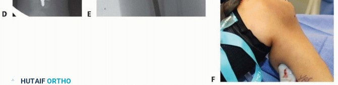 Illustration 31 for Less Pain, More Function: Fassier-Duval Nailing for Osteogenesis Imperfecta