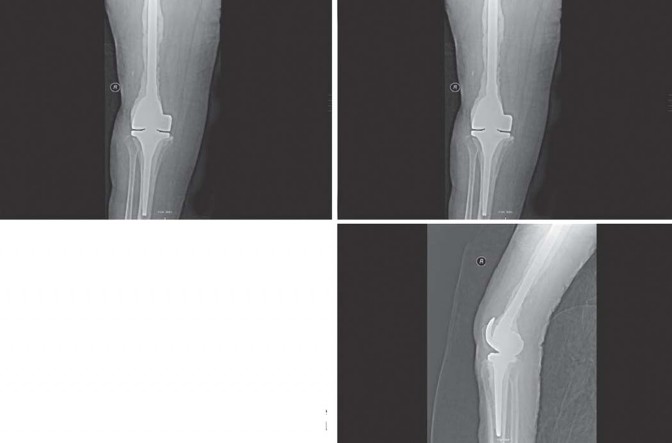 Illustration 85 for Optimizing Infected THA: The One Staged Approach Explained