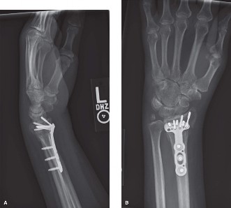 Illustration 2 for Radius Fracture Distal: Prevent CRPS & Uncover Instability Signs