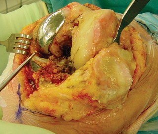 صورة طبية: مراجعة استبدال الركبة الجزئي الفاشل دليلك الشامل للعلاج الناجح في صنعاء