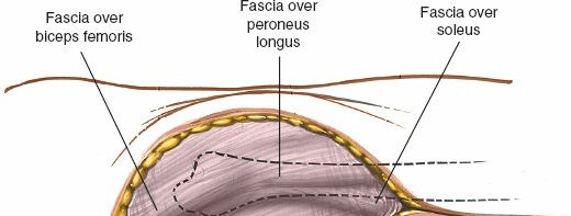 Illustration 90 for Surgical Access: Mastering the Tibia's Surface & Fibula Approaches