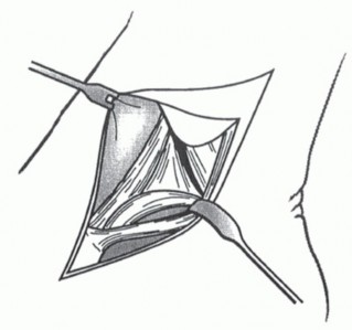 Illustration 20 for Medial Ankle Instability: Find Relief with Reconstruction