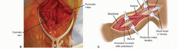 Illustration 12 for Surgical Approaches to Shoulder & Elbow: Pearls and Pitfalls