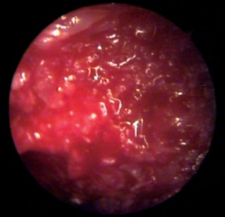 Illustration 21 for Cemented Femoral Stem Figures: Surgical Anatomy & Placement