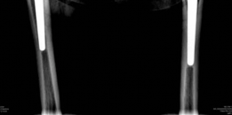 Illustration 3 for Revision THA Acetabulum: Overcoming Paprosky IIIA & Metallosis