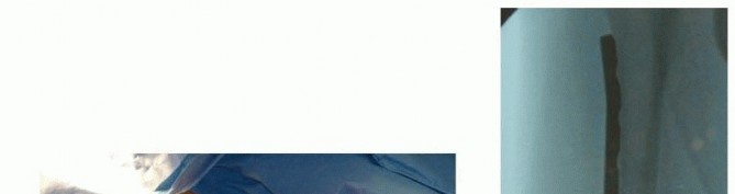 Minimally Invasive Submuscular Plating for Pediatric Femur Fractures