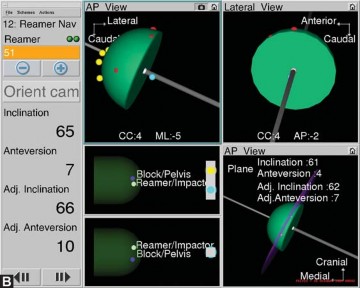 Illustration 21 for Avoiding Errors: Navigation in Total Hip Arthroplasty