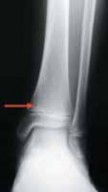 Illustration 20 for Pediatric Ankle Fractures: Management to Prevent Long-Term Issues