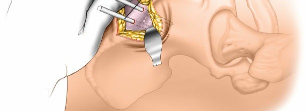 Illustration 23 for Key Approaches for External Fixation: Humerus, Radius, Ulna, Wrist