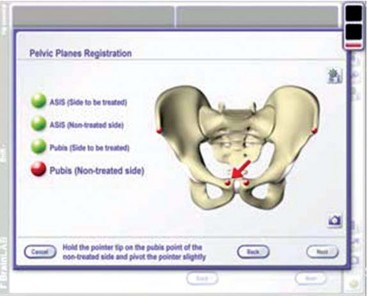 Illustration 21 for Minimizing Risks: Computer Navigation in Hip Resurfacing Arthroplasty