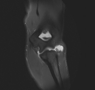 Pinpointing Collateral Ligament Instability in Elbow Injuries