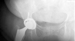 Illustration 16 for Mastering Direct Anterior Approach Hip Arthroplasty Without a Traction Table