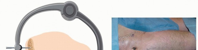 Illustration 30 for Emergency Fixation of the Pelvis: Control Bleeding & Restore Stability