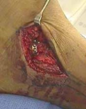 Illustration 37 for Talar Neck Fracture Treatment: Optimizing Recovery with ORIF