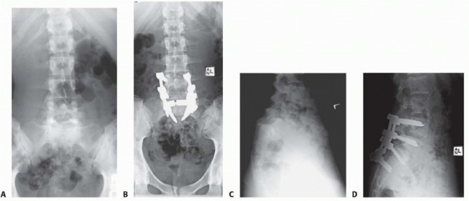 Illustration 20 for Mastering High-Grade Spondylolisthesis: Posterolateral and Interbody Fusion