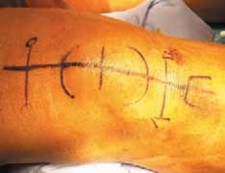 Repairing Chronic Quadriceps Tendon Ruptures: A Definitive Guide