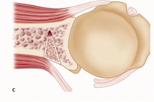 Illustration 33 for Mastering the Treatment of Recurrent Posterior Shoulder Instability