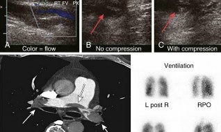Illustration 9 for Perioperative & Orthopaedic Medicine: Preventing Dangerous Blood Clots
