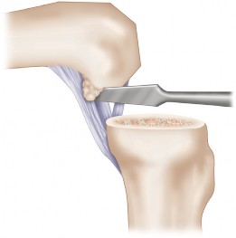 Illustration 7 for Posterior Cruciate Ligament-Retaining TKA: Navigating Pitfalls