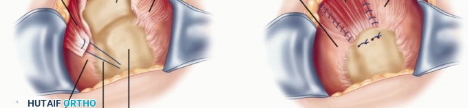 Illustration 23 for Subscapularis & Teres Rotator Cuff Repair: Advanced Techniques