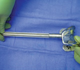 Illustration 26 for Uncemented Stems in Revision: A Guide to Success & Pitfalls