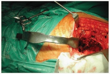 Illustration 5 for Why Polished Tapered Cemented Stems Excel in Hip Replacement