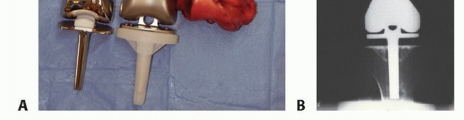 Illustration 17 for Distal Femoral Replacement: Key to Modern Limb Salvage