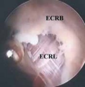 Illustration 9 for Unlock Relief: Arthroscopic Treatment of Epicondylitis Explained