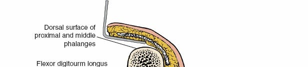 Illustration 163 for Essential Surgical Approaches: Uncover Every Aspect of the Wrist
