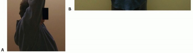 Illustration 41 for Restore Shoulder Function with Latissimus Dorsi Tendon Transfer