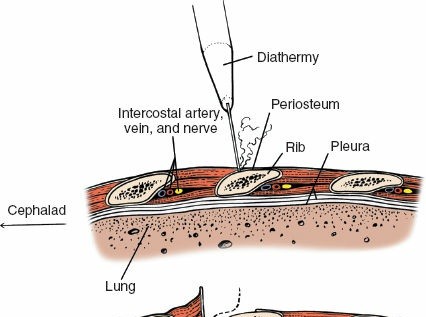 Illustration 317 for Approach to the Lumbar Spine: Mastering Techniques & Anatomy