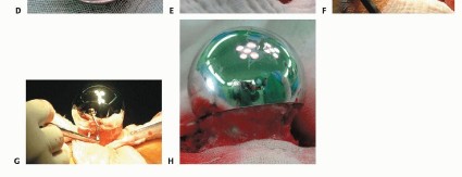 Illustration 18 for Hip Resurfacing: The Bone-Sparing Solution around the Femoral Head
