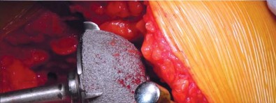 Illustration 19 for Unlock better THA: The technique of short stem for less invasiveness