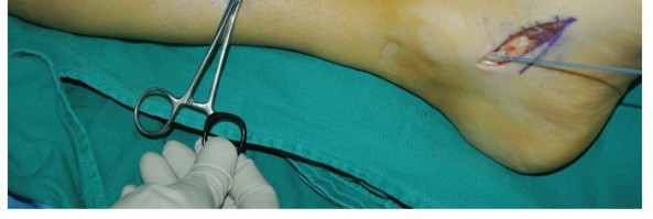 Illustration 41 for Restore Movement: Tendon Transfer for Common Peroneal Nerve Foot Drop