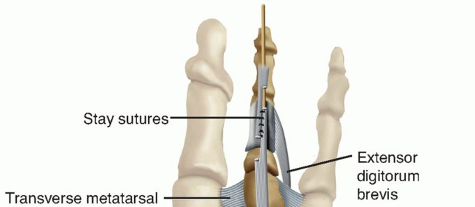 Illustration 10 for Toe Deformity Pain? Rebalance Flexor to Extensor for Relief