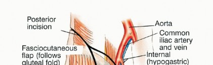 Illustration 17 for Surgical Pelvic Resection: Gluteus Maximus Muscle & Nerve Preservation